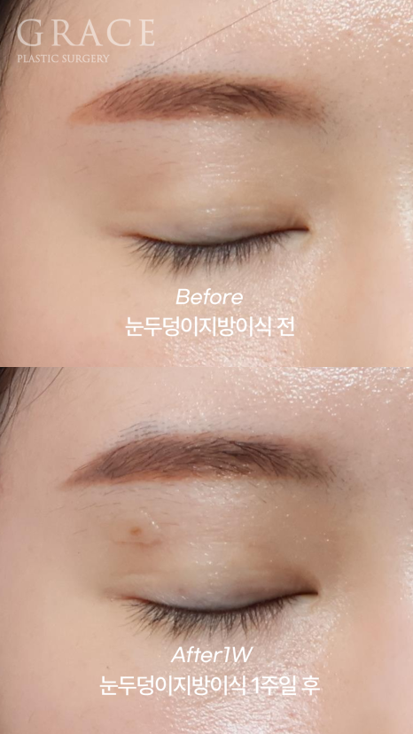 아이홀 꺼짐은 MZ도 예외 없다 눈두덩이 지방이식으로 짝눈교정 관련 이미지 4