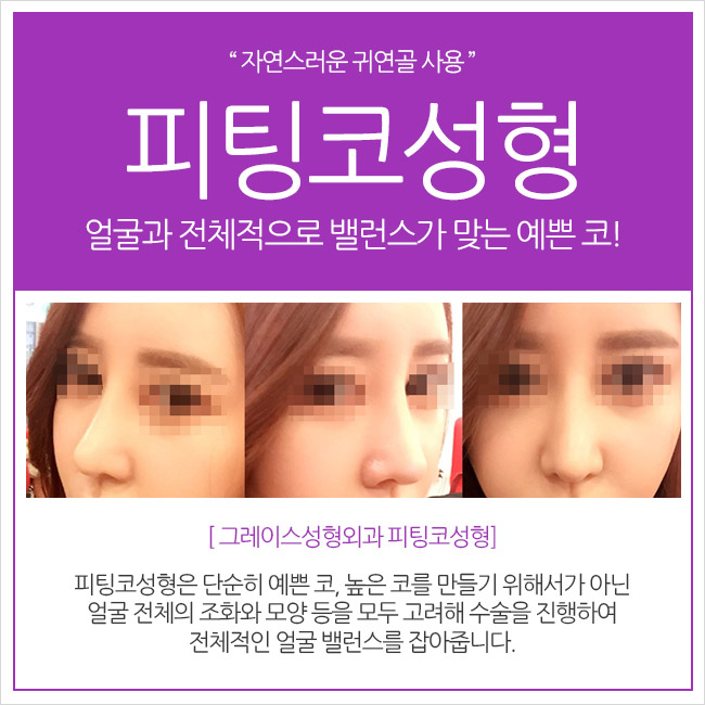 귀연골 사용, 그레이스성형외과 피팅코 관련 이미지 3