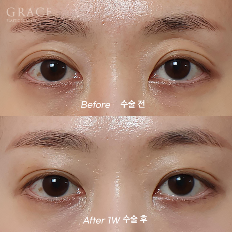 눈꺼풀지 방이식 심하게 꺼진 40대 눈 위 7일 만에 얼마나 달라졌을까? (그레이스성형외과 눈두덩이지방이식) 관련 이미지 6