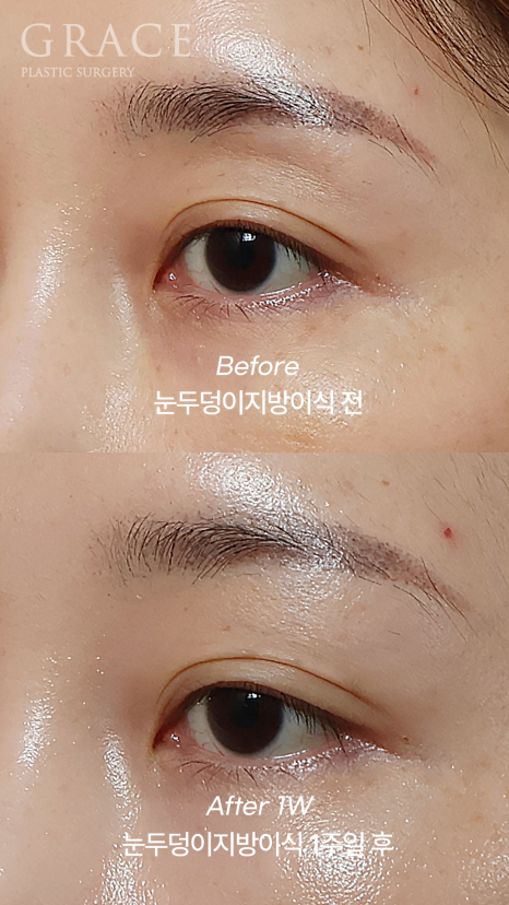 눈 감았을 때 울퉁불퉁? 실제 눈두덩이지방이식 전후 관련 이미지 3