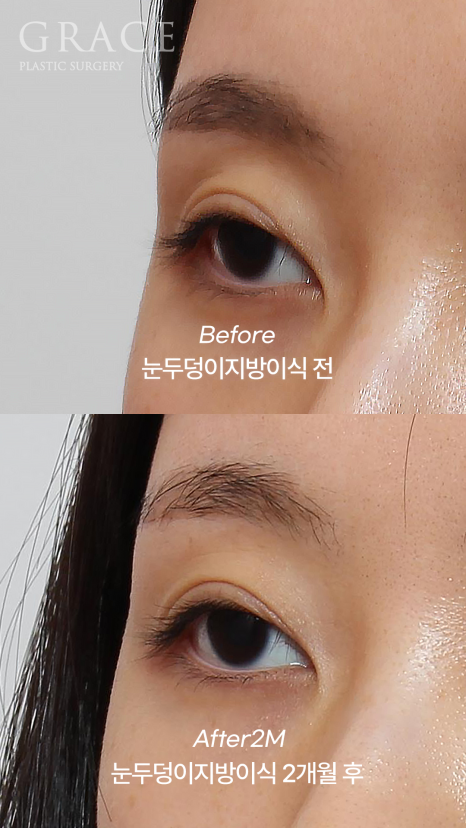 Upper Eyelid Fat Grafting That Shows When You Close Your Eyes? The Cause of Side Effects Is Different image 6