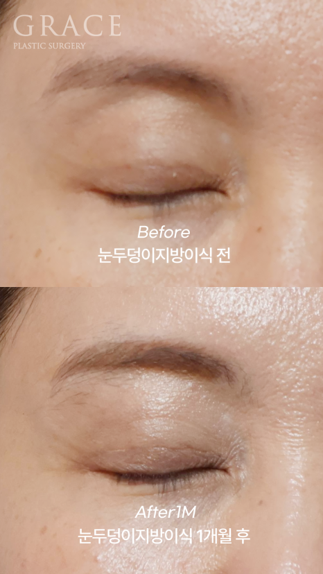 눈꺼풀 지방이식 보법이 다른 최문섭 원장님 실력 관련 이미지 2