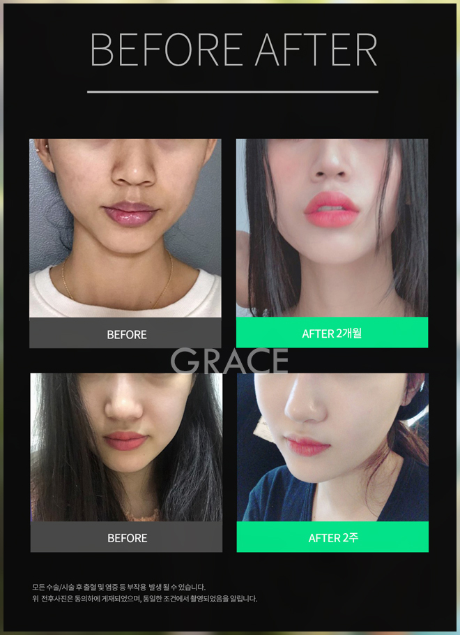 다크써클수술가격 눈밑이 밝아져요 관련 이미지 4