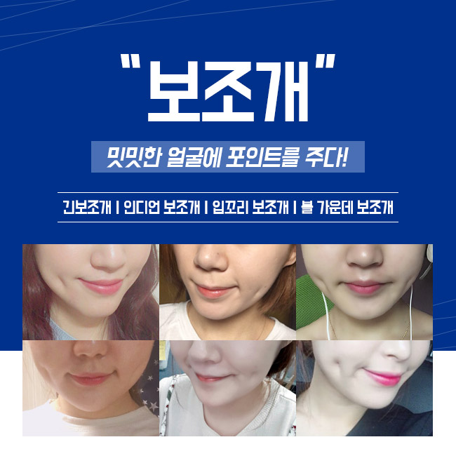 그레이스성형외과 김윤호원장님의 보조개수술 관련 이미지 5