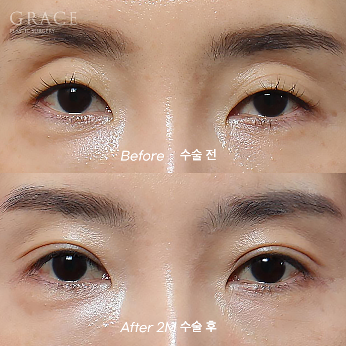 눈두덩이 지방이식 걱정만 덜기 관련 이미지 9
