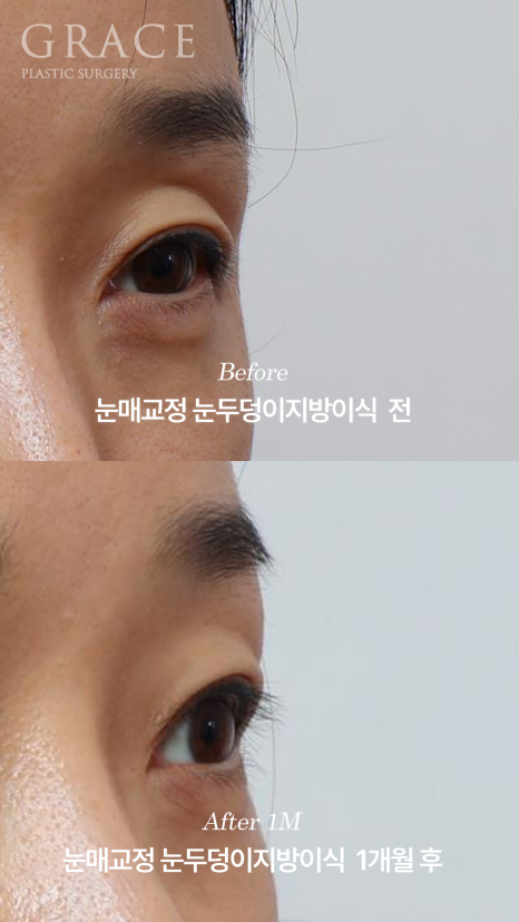 눈성형 부작용 후 재수술 안검하수 교정과 눈두덩이지방이식 1개월 경과 관련 이미지 6
