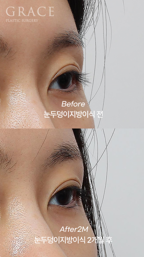 Upper Eyelid Fat Grafting That Shows When You Close Your Eyes? The Cause of Side Effects Is Different image 7