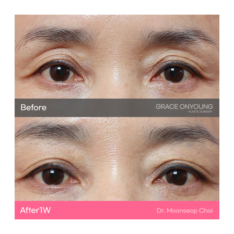 Eyelid Fat Grafting (Sunken Eye Hollowing) image 5