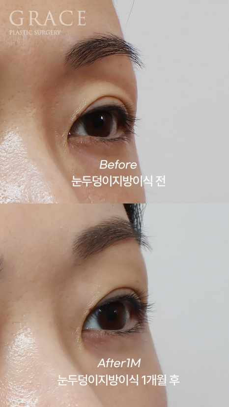 How Long Does Upper Eyelid Fat Grafting Last? The Facts About Maintenance Period image 7