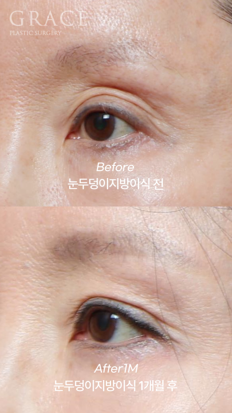 꺼진 아이홀 눈꺼풀 지방이식 (얇은 피부 부작용 붓기 등) 관련 이미지 2