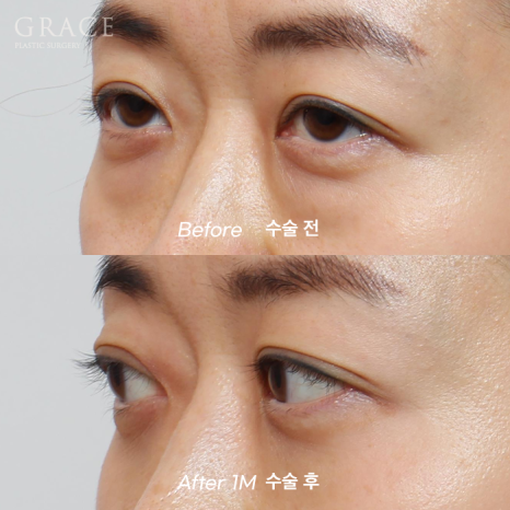 Hollow Eye Holes + Under-Eye Puffiness → (Upper Eyelid Fat Grafting + Fat Repositioning) image 5
