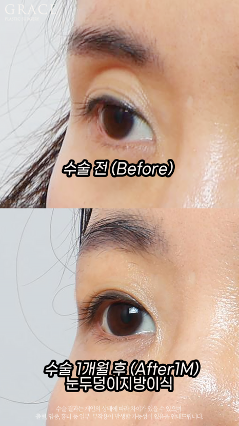 눈두덩이 지방이식으로 젊음을 되찾다: 70대, 40대 시술 전후 비교 관련 이미지 7
