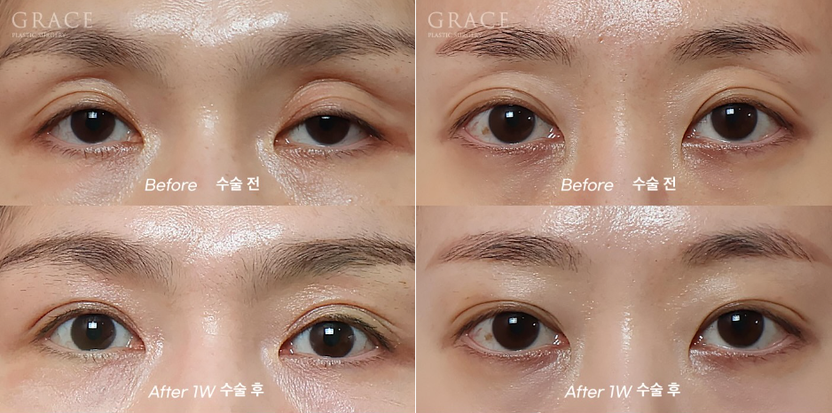 Why Do Hollow Eyelids Occur, and How Can They Be Naturally Improved? (Research Notes from a Doctor Performing Eyelid Fat Grafting) image 13