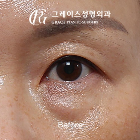 A Complete Guide to the Best Combination of Midlife Eye Surgery, from Under-Eye Fat Repositioning Costs to an I-Hole Filler Alternative image 1