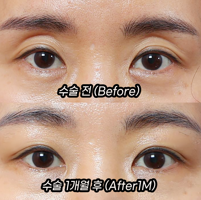 눈두덩이 지방이식으로 젊음을 되찾다: 70대, 40대 시술 전후 비교 관련 이미지 5