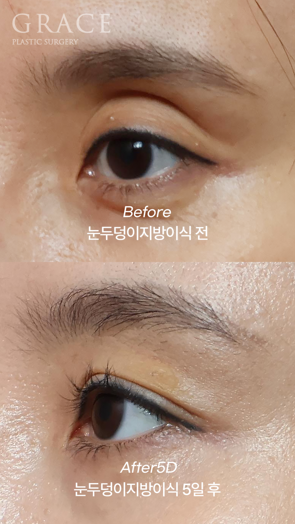 Why Eyelid Hollow Fat Grafting and Orbital Fat Injection Are Important: From Duration of Results to How to Prevent Bumpy Side Effects image 13