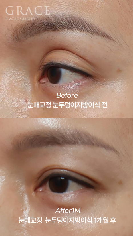 Is Eyelid Fat Grafting in Your 40s Required to Include Ptosis Correction? It Depends on Your Eye Condition image 3