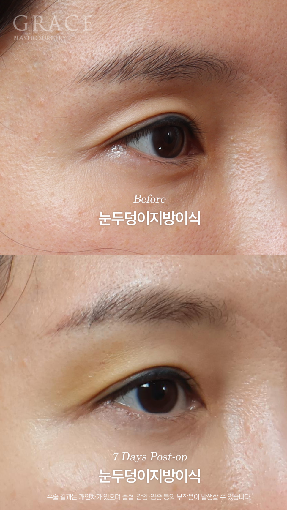 눈두덩이지방이식 하고 일주일 출근 가능한 정도일까? 관련 이미지 4