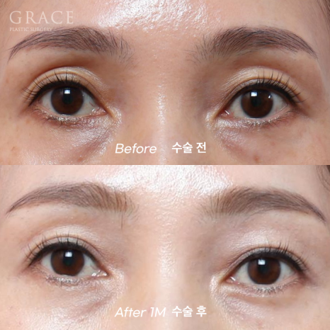 그레이스성형외과 Before&middot;After 아이홀 지방이식 잘하는 곳 관련 이미지 8