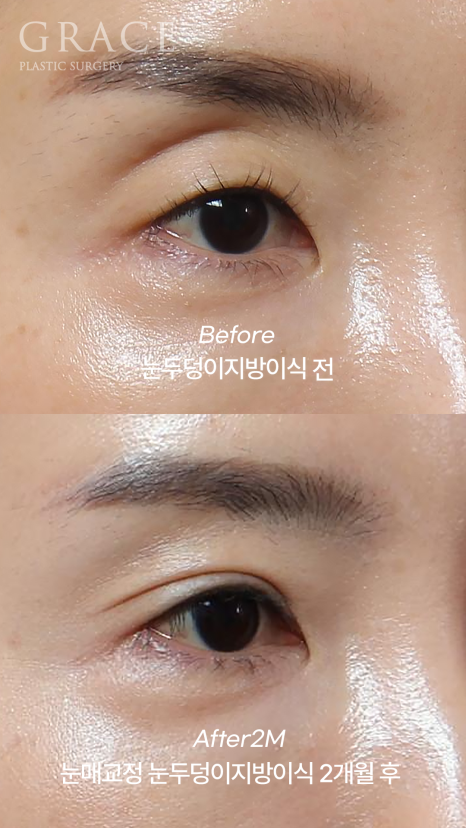 눈두덩이 지방이식 걱정만 덜기 관련 이미지 5