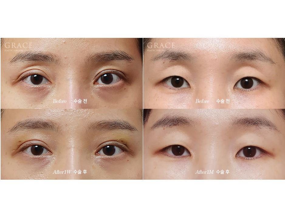 눈두덩이 부위에 절개해서 지방을 넣는다? 그레이스성형외과 아이홀 지방이식 방식에 대한 오해 관련 이미지 8