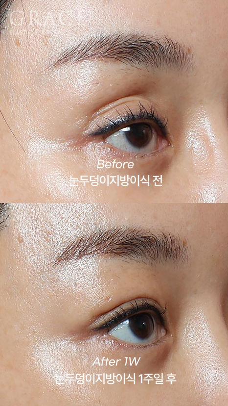 돌출눈성형 전후 움푹 패인 눈꺼풀 지방이식 관련 이미지 4