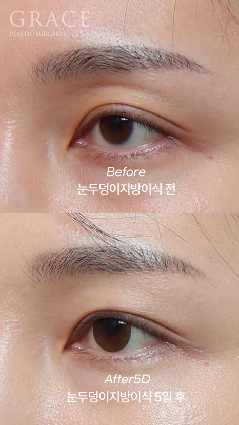 Eyelid Fat Grafting Bruising and Swelling Side Effects (Natural Eyelid Line After 5 Days) image 2