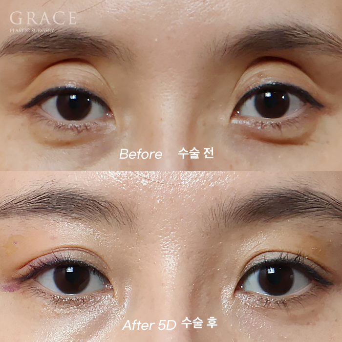 Upper Eyelid Fat Grafting, Yellow Bruising and Swelling (... Changes Noted After 5 Days) image 1