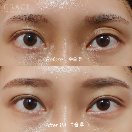 Why Choose Upper Eyelid Fat Grafting Instead of Eye-Hollow Filler? image 13