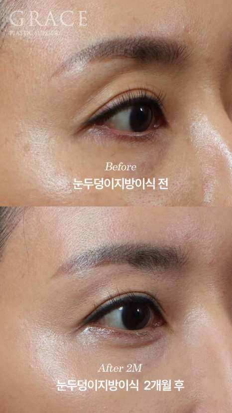 Is a Second Eyelid Fat Grafting Necessary? Are Frozen Fat Grafts a Side Effect? image 4