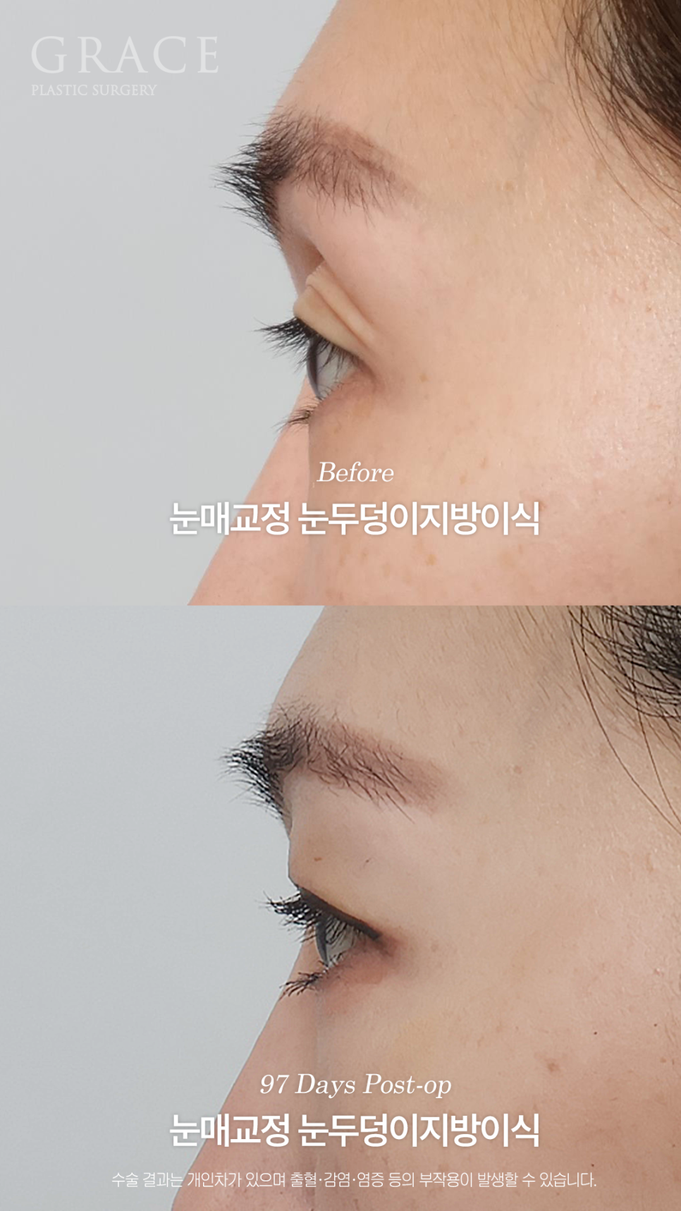 그레이스성형외과 눈두덩이 지방이식 1차로 끝내지 않은 진짜 이유 관련 이미지 9