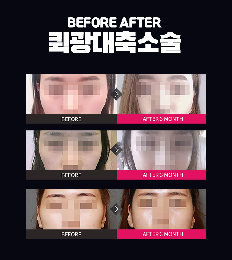 그레이스성형외과 퀵광대축소술 11월&hearts; 관련 이미지 5