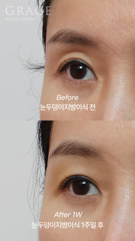 One-Week Changes After Eyelid Fat Grafting: Sunken Eye Hollows Regain Volume image 4