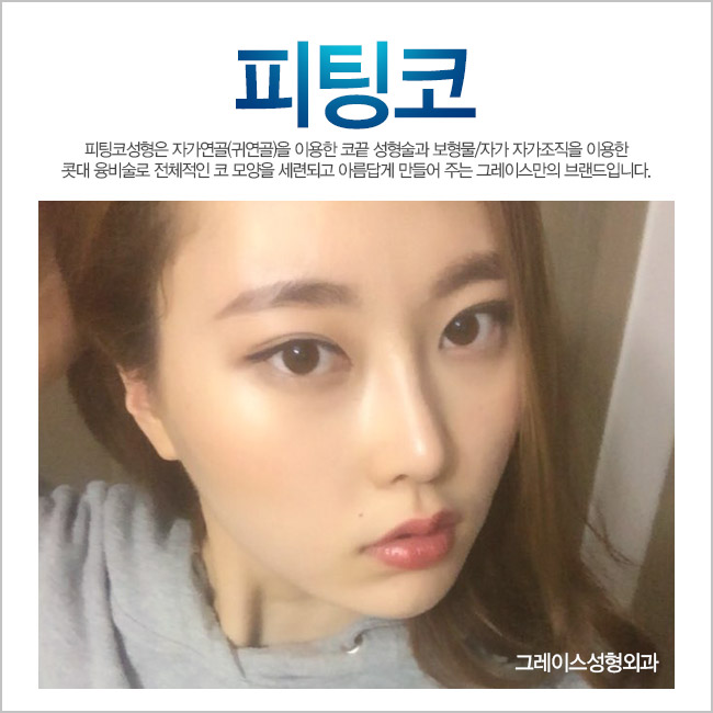 매일 버스에서 보던 코성형, 그레이스성형외과 피팅코성형 관련 이미지 1