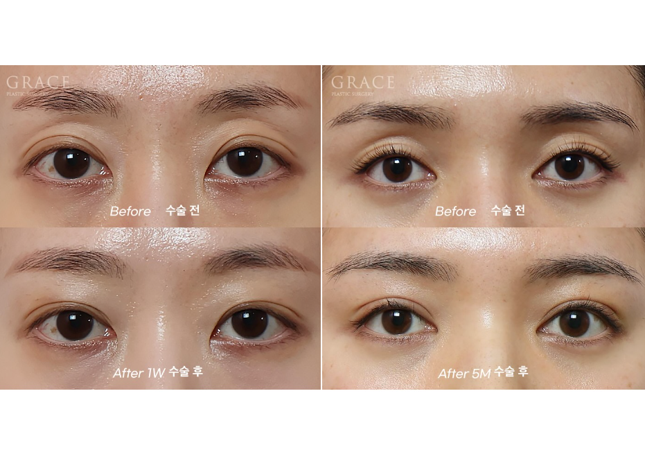 Grace Plastic Surgery Sunken Eye Hollows Upper Eyelid Fat Grafting image 4