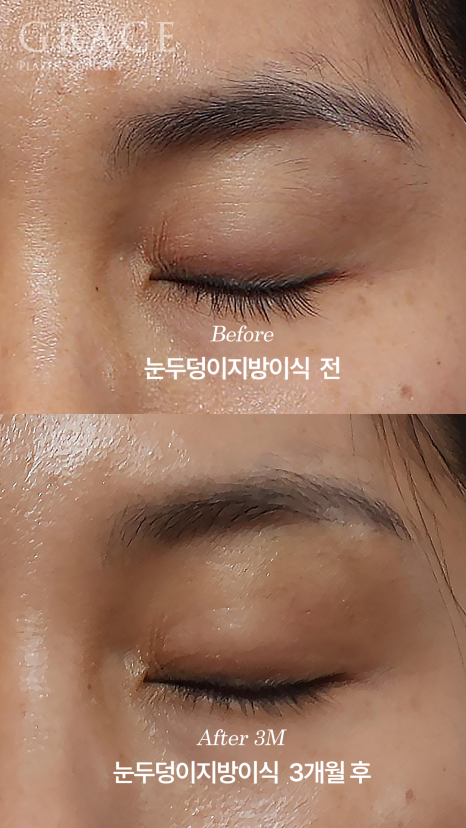 안와지방 주입 &middot; 눈두덩이지방이식 (1cc / 0.9cc) 관련 이미지 4