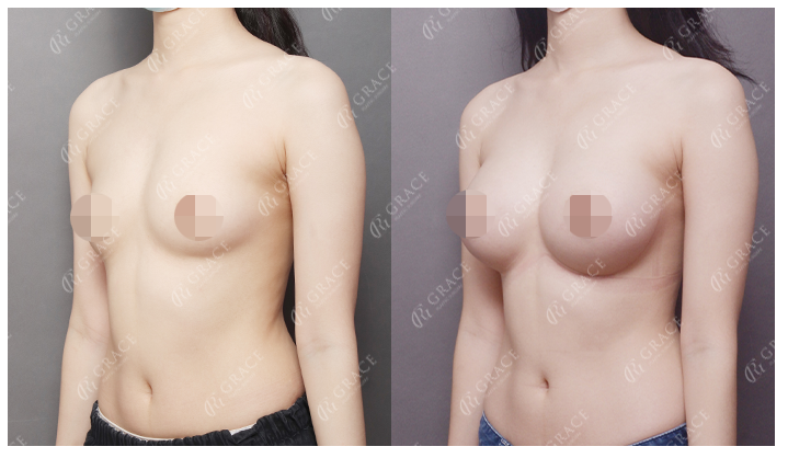 How Should You Choose a Good Breast Augmentation Clinic? image 5