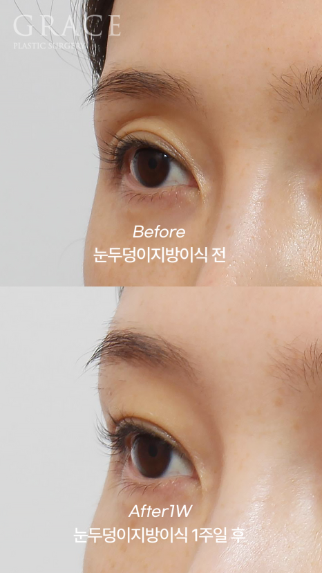 Will Eye Hollow Fat Grafting Really Deflate After 1 Month? 1-Week vs 2-Month Before-and-After Comparison image 6