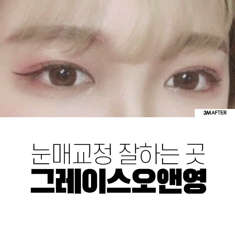 비절개눈매교정 전후 알아보자💕 관련 이미지 4