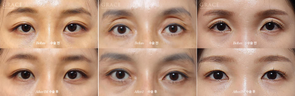 3 Things You Must Know Before Eyelid Fat Grafting image 1