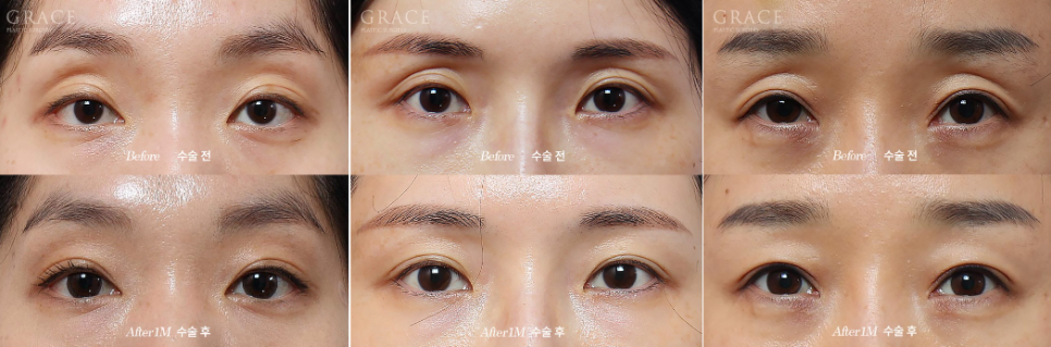 Why Does Fat Grafting to the Upper Eyelids Require a Different Approach from the Lower Eyelids? image 2