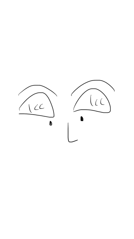 눈꺼풀 지방이식 눈 감았을 때 울퉁불퉁하지 않는 이유 전후사례로 보여드립니다 관련 이미지 11