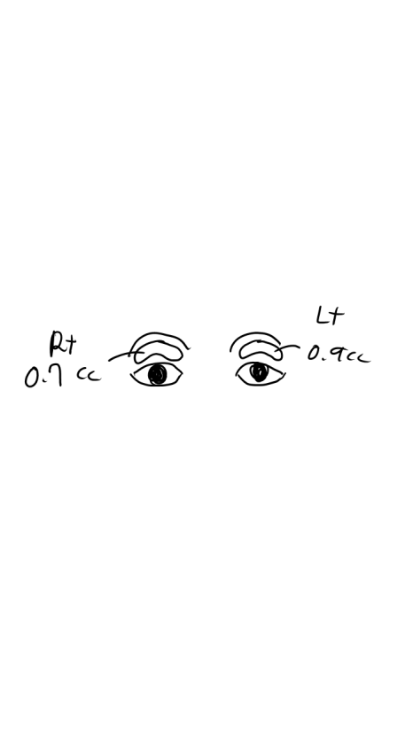 Double Eyelid Fat Grafting Fails When It Becomes Visible and Bumpy? image 2