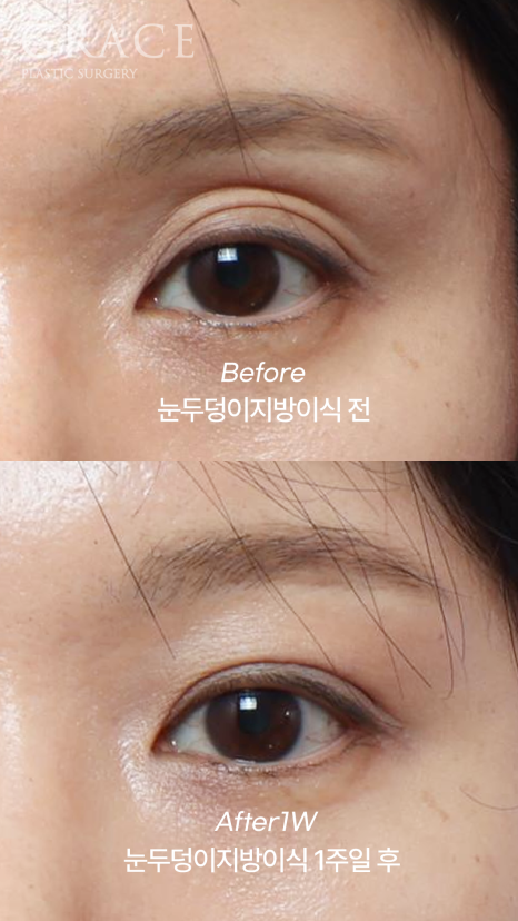 눈두덩이 지방이식 가격보다는 주입방식 관련 이미지 1
