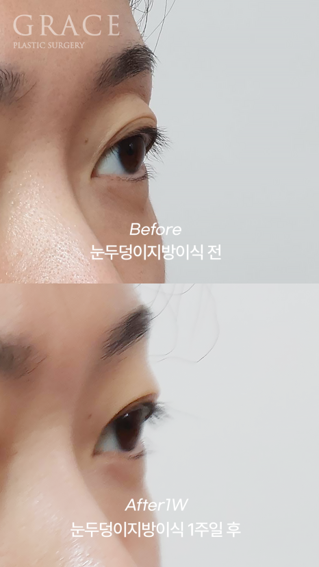No to Frozen Fat That’s Completely Frozen! Eyelid Fat Grafting with Only Fresh Autologous Fat image 4