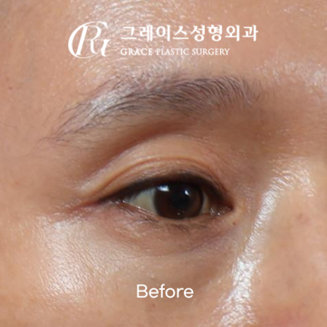 꺼진 눈 성형 1주일 붓기 보정 없이 솔직하게 보여드립니다 관련 이미지 4
