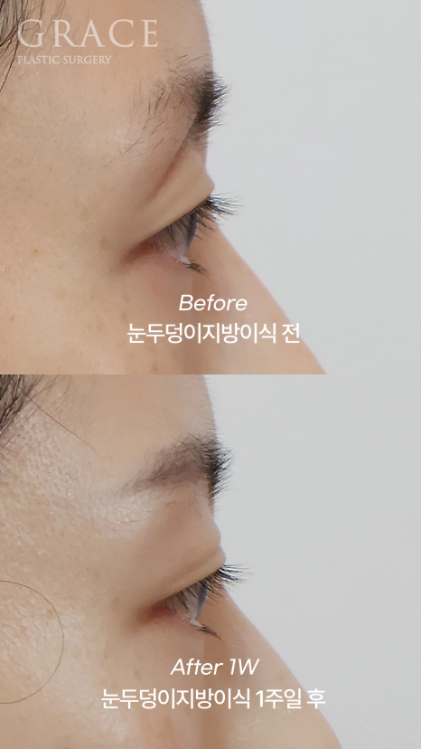 The Basis for a 94.5% Functional Improvement: Fat Grafting Technology That Fills in a Sunken Eye Hollow image 5