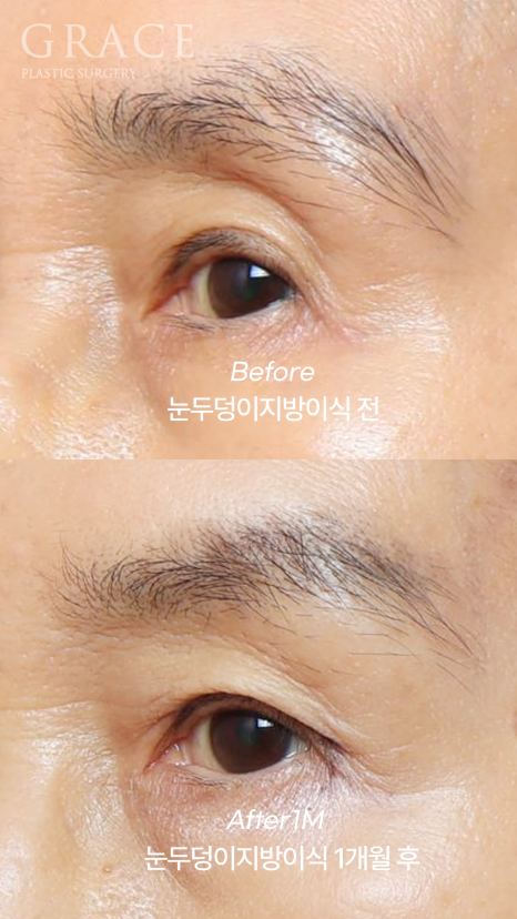 Will eyelid fat grafting be finished in one session? Progress after the first graft for a customer in their 60s and the planned second graft image 5
