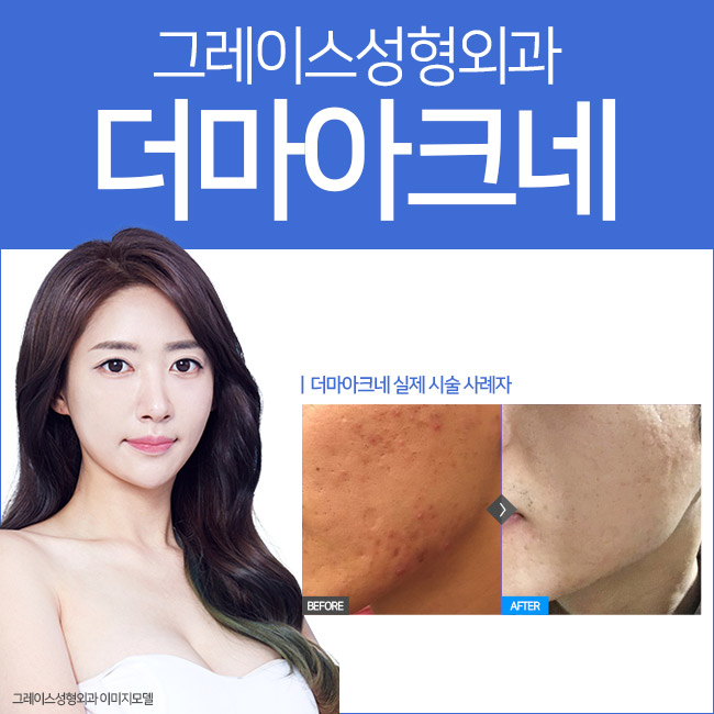 더마아크네 여드름의 원인 파괴와 재발을 예방하다 관련 이미지 1
