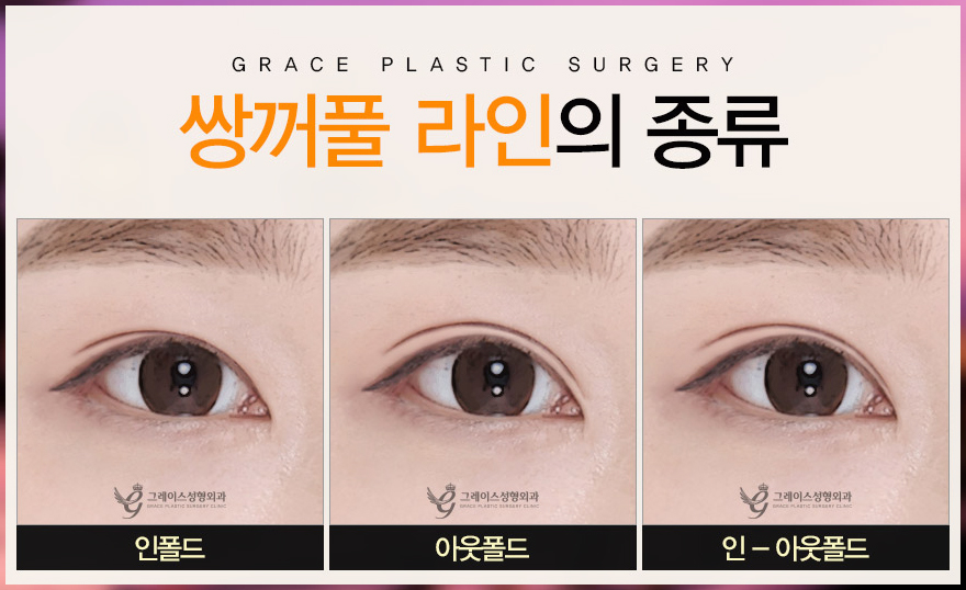 쌍수종류 자연유착?절개? 그레이스가 알려드려요 관련 이미지 2